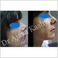 Invasive Facial Rejuvenation